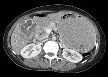 Figure 9: locally aggressive lesion showing infiltrative gallbladder mass invading the antro-pyloric region, first and second part of duodenum. Patient had gastric outlet obstruction. Incarcerated calculi can be seen.